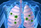 Viêm phổi: Cách chẩn đoán và điều trị