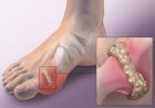 Bệnh gút là gì? Nguyên nhân, triệu chứng và cách điều trị