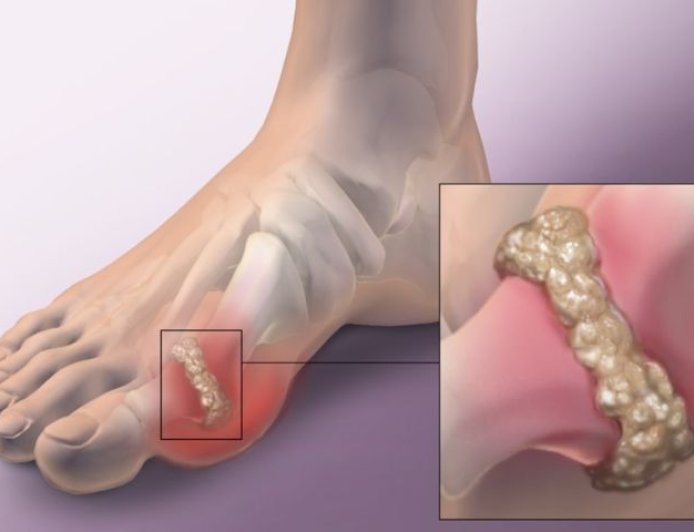 Bệnh gút là gì? Nguyên nhân, triệu chứng và cách điều trị