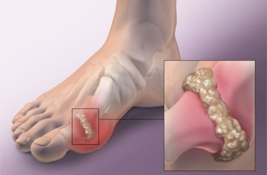 Bệnh gút là gì? Nguyên nhân, triệu chứng và cách điều trị